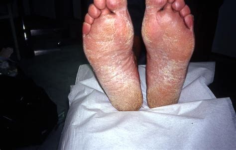 SUPERFICIAL FUNGAL INFECTIONS - Tinea pedis (Athlet's foot) picture | Hellenic Dermatological ...