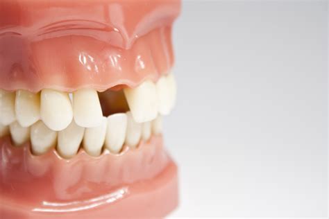 6 Dental Effects of Missing a Tooth | Consumer Guide to Dentistry