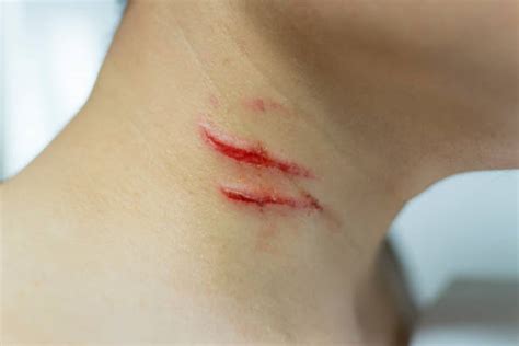 Skin Abrasion Stock Photos, Pictures & Royalty-Free Images - iStock