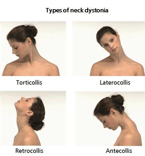 Types-neck-dystonia-e | Complete Spine and Pain Care