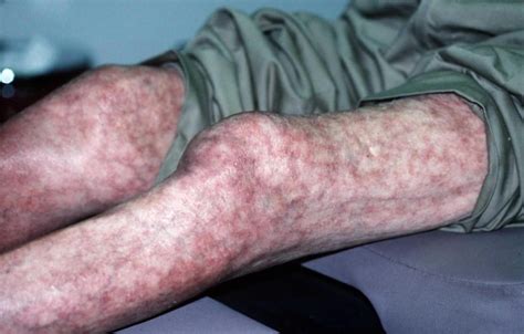 Mottled skin or livedo reticularis causes, diagnosis and treatment