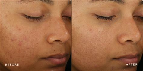 Microdermabrasion at Laser + Skin Institute | Chatam, New Jersey