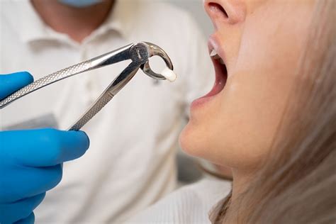 A Step-by-step Guide to a Tooth Extraction Procedure - Lasting ...