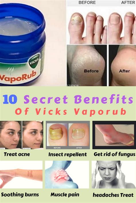 The Ultimate Guide: Using Vicks Vaporub To Combat Pesky Pimples