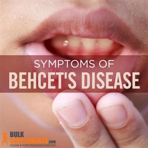 Behcet's Disease: Symptoms, Causes & Treatment