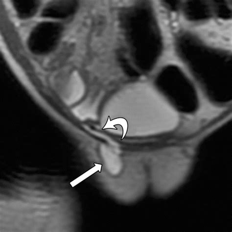 From Inguinal Hernias to Spermatic Cord Lipomas: Pearls, Pitfalls, and ...