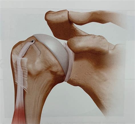 Biceps Tenodesis Procedure