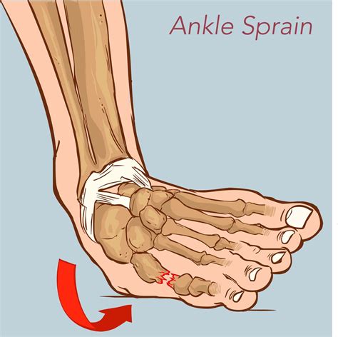 Illustration Showing A Sprained Ankle Ankle Sprain Symptoms Sprained | Hot Sex Picture