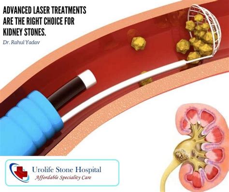 Laser Kidney Stone Surgery in New Delhi! in 2021 | Treat kidney stones ...