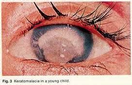 Keratomalacia and Liver Disease