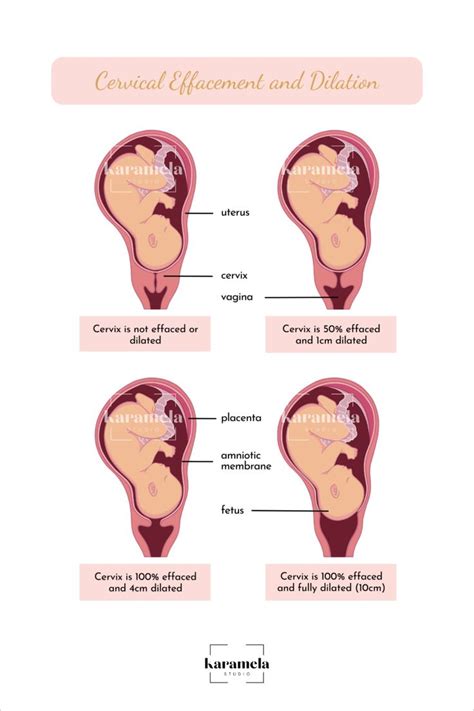 Printable Diagram of Cervical Effacement and Dilation Birth - Etsy in ...