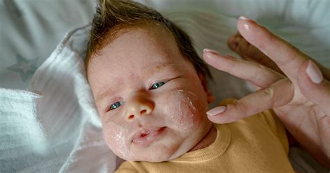 Eczema on Child's Face: Causes, Diagnosis, Treatment, and More