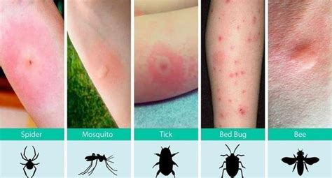 How to recognize various bug bites : coolguides | Insect bites and stings, Insect bites, Bites ...