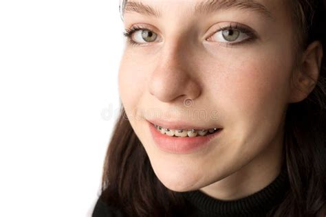 Orthodontic Treatment. Dental Care Concept. Smiling Teenage Girl with Braces. Metal Braces Close ...