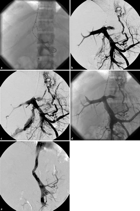 The Intravascular Ultrasound–Guided Direct Intrahepatic Portacaval ...