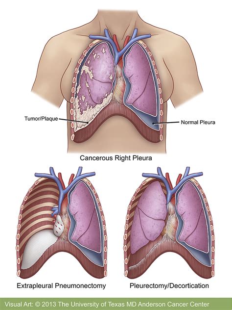 What Is The Ribbon Color For Skin Cancer