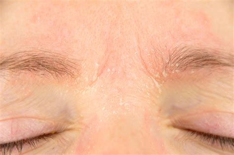 Itchy Eyebrows: Common Causes, Symptoms and Treatments