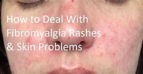 By : Brenda Vanta Dealing With Fibromyalgia Rash Often when we think ...