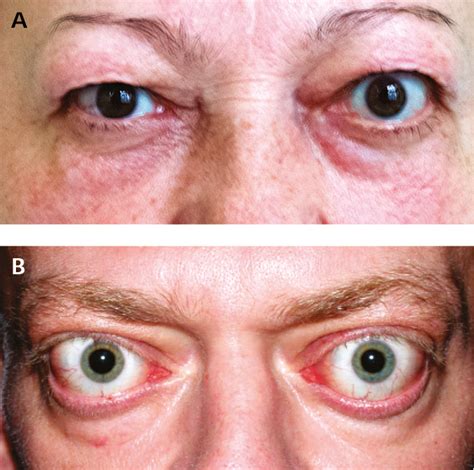 Figure 031_2_9057. Thyroid-associated orbitopathy. A , mild orbitopathy (eyelid retraction, mild ...