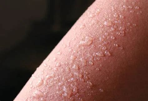 Sunburn (Sun Poisoning) Symptoms, Cancer, Treatment & Remedies