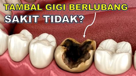 Tambal gigi berlubang sakit tidak 🙄 - YouTube