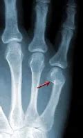 Broken Finger: Symptoms, X-Rays, Tips, Treatment, Surgery & Pictures