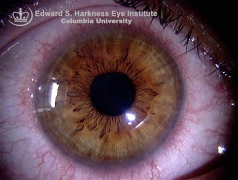 Corneal Neovascularization | Vagelos College of Physicians and Surgeons