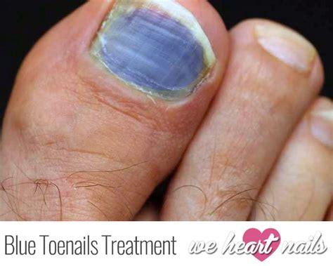 Bruised Blue Toenails? | Causes, Prevention & Treatments