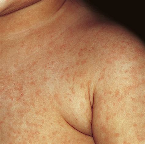 German Measles - Pictures, Symptoms, Causes, Treatment