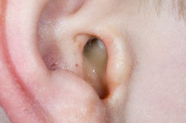 Ear Infection