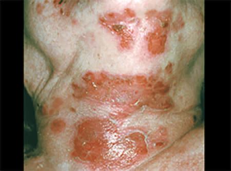 Pemphigus: Signs and symptoms