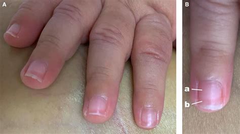 Terry’s nails in an infant with liver cirrhosis | Archives of Disease in Childhood