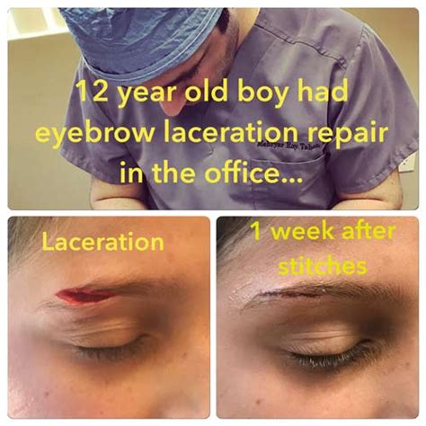 Eyelid Laceration Surgery by Beverly Hills Plastic Surgeon