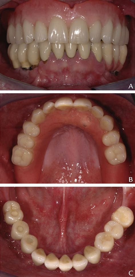 A, Occlusal view of maxillary overdenture. B, Intraoral view of... | Download Scientific Diagram