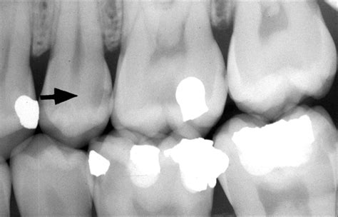 Fillings on Decayed Teeth — Thousand Oaks Family Dentistry | Thousand Oaks Dentist