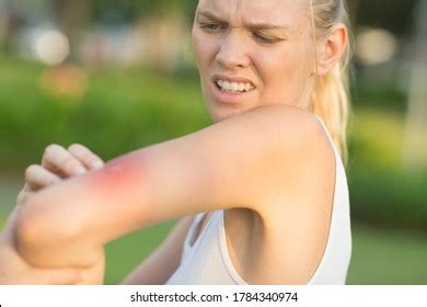 Itchy Insect Bite Irritated Young Female Stock Photo 1784340974 | Shutterstock