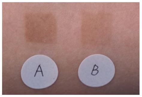 Cosmetics | Free Full-Text | Mechanism of Action of Topical Tranexamic ...