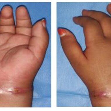 Circumferential scar over right wrist. | Download Scientific Diagram