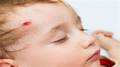 Childhood Head Injury May Up Mental Illness, Mortality Risk - Boldsky.com