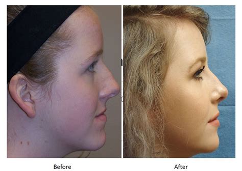 Jaw Surgery Before And After