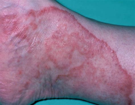 Ringworm or athlete's foot a dermatophyte infection caused by a fungus | GRAPHIC CONTENT ...