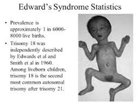 Trisomy 18 known as Edwards Syndrome | Strive For Good Health