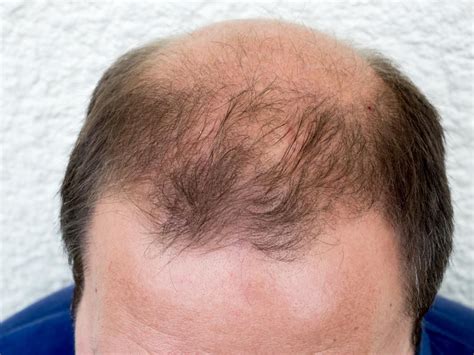 1 year male pattern baldness reversal how i did it – Artofit