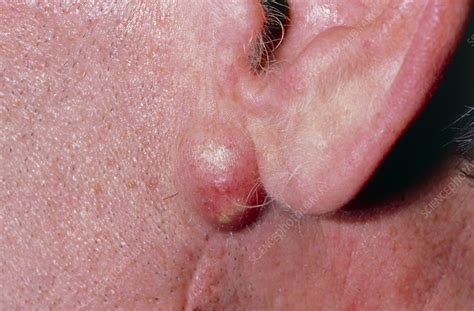 Infected sebaceous cyst on man's jaw (under ear) - Stock Image - M130/0165 - Science Photo Library