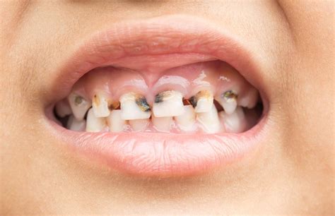 Calcium Deficiency Teeth - Tribuntech