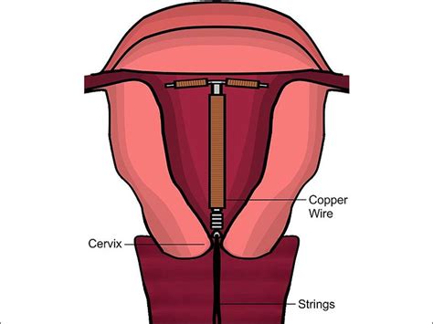 Iud In Uterus Diagram