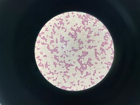 Solved This is Haemolytic anemia under a microscopeDescribe | Chegg.com