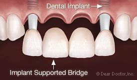 dental-implant-supported-bridge - Michael E. Krone, D.D.S. Family Dentistry