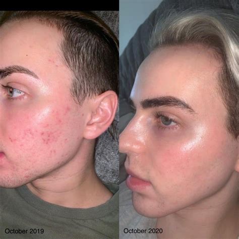 adapalene acne scars before after - Vanessa Anderson