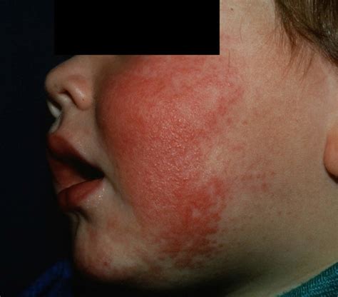 Stages Of Fifth Disease Rash